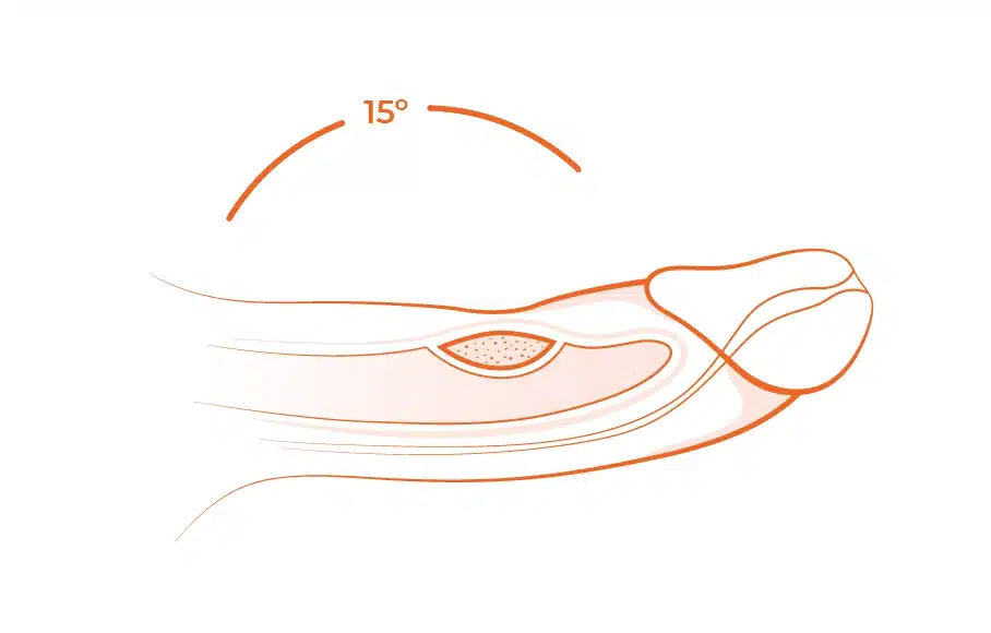 15 degree peyronie's disease at assoicated urological specialists