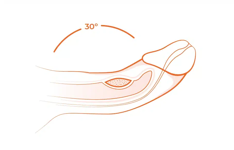 30 degree peyronie's disease at assoicated urological specialists