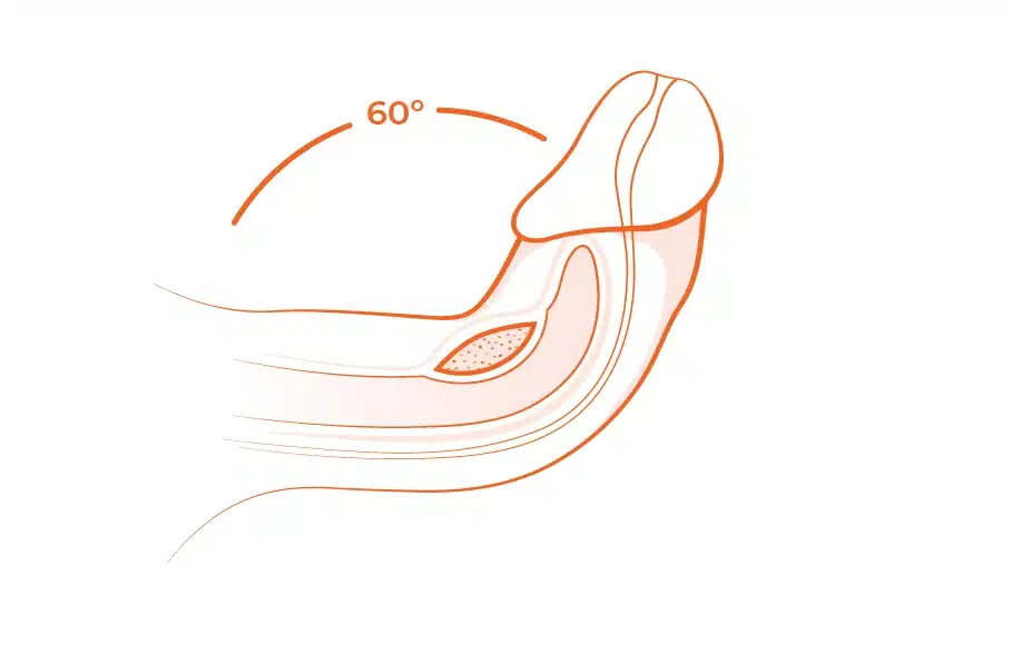 60 degree peyronie's disease at assoicated urological specialists