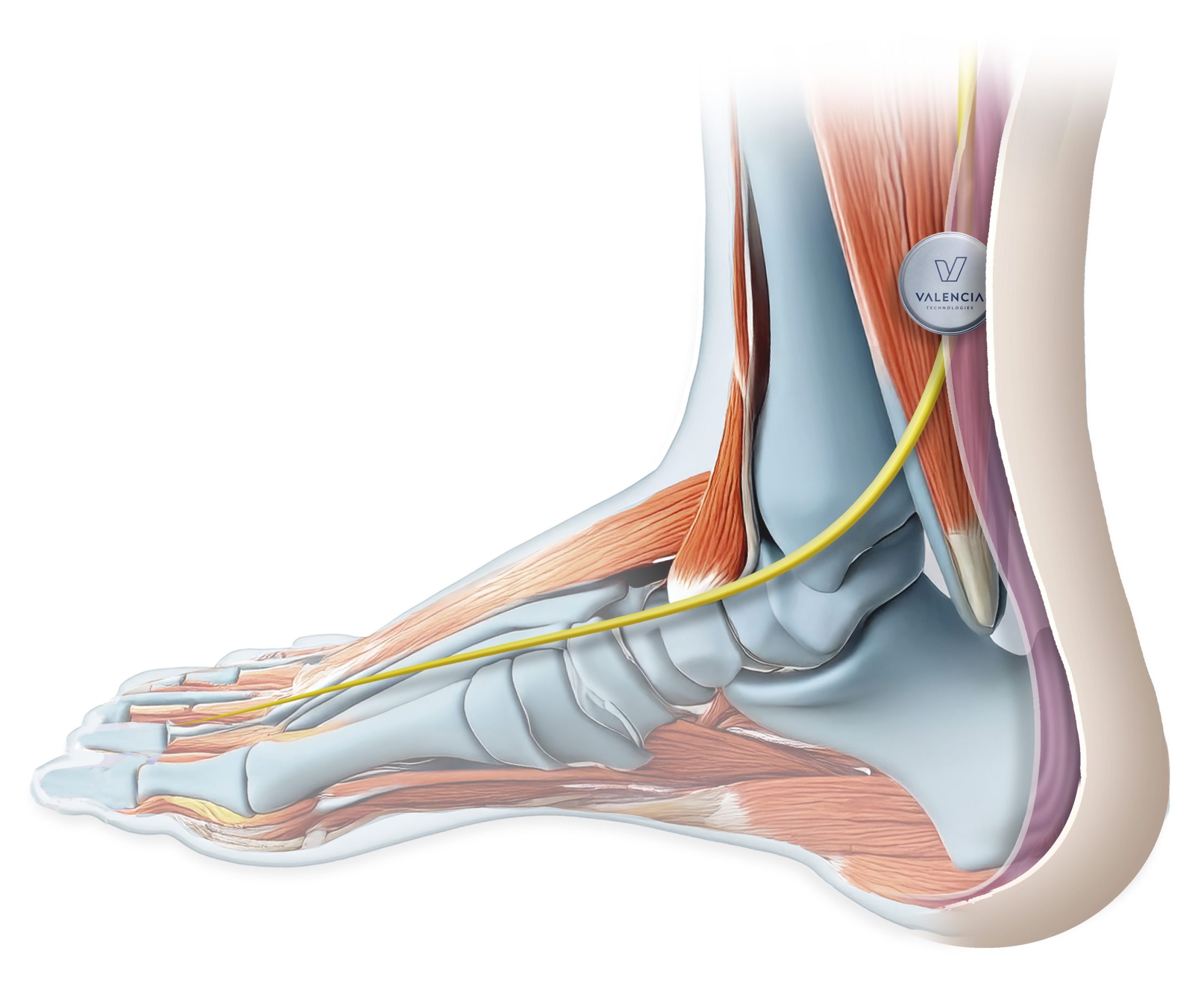 eCoin placement in ankle